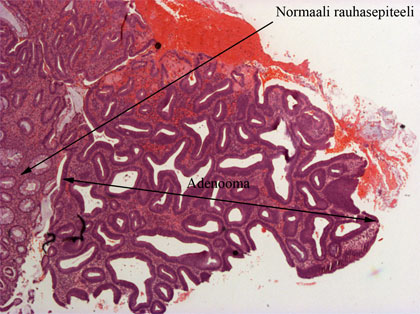 Tubulaarinen Adenooma