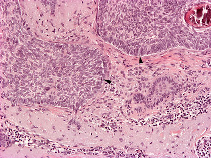 Solunetti Tyvisolusy p carcinoma Basocellulare 100x Solunetti Tyvisolusy p carcinoma Basocellulare 100x