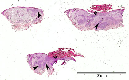 Solunetti Tyvisolusy p carcinoma Basocellulare N yte Solunetti Tyvisolusy p carcinoma Basocellulare N yte